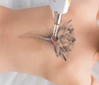 laser tattoo removal from back 