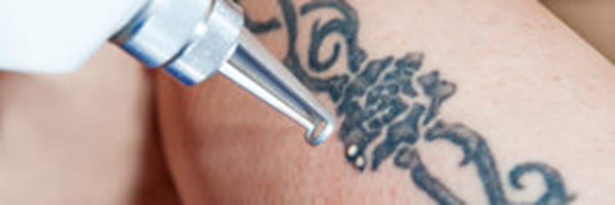 Laser Tattoo Removal Sydney - The #1 Rated Tattoo Removal Clinic // Think  Again Laser Clinic